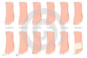 Ingrown toenails, diseases of the toes. Treatment and care of problem nails. Vector illustration