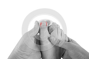 Ingrown toenails on a woman`s foot, isolated on white background, pain in the big toe photo