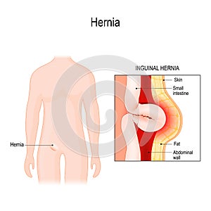 Inguinal Hernia. bowel exit through the wall of the abdomen cavity