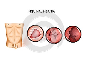 Inguinal hernia entrapment