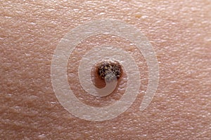 The initial stage of melanoma