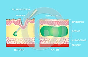 injectable cosmetic filler or Dermal fillers