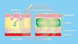 injectable cosmetic filler or Dermal fillers photo