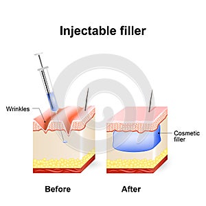 Injectable cosmetic filler. How it works photo