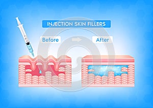 Injection filler injection under the skin on face with wrinkle dermal layer before and after. Facial hyaluronic acid. Medical and