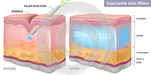 Injection filler injection under the skin, vector illustration