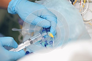 Injection of medication into the catheter
