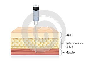 Injection needle insert medications into the muscle layer of skin.
