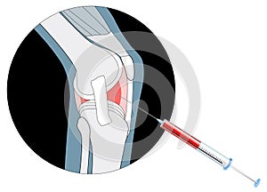 injection into the painful joint