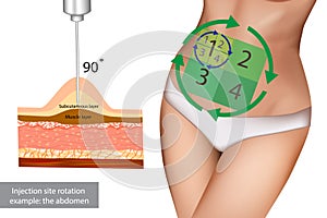 Injection site rotation example: the abdomen