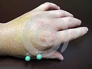 Injured Hand with Surgical Pins