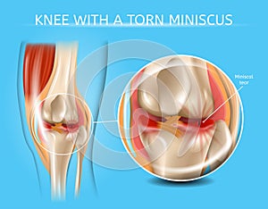 Injured Knee Joint with Torn Meniscus Vector Chart