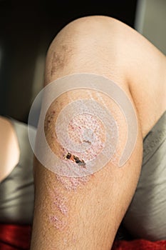 Injured knee with scar from abrasion healing