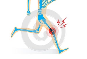 Injury of knee bone and leg while running