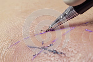 ink pen marking skin for incision