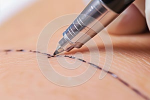 ink pen marking skin for incision photo