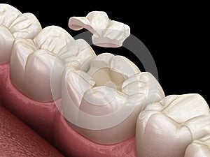 Inlay ceramic crown fixation over tooth. Medically accurate 3D illustration of human teeth