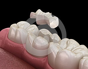 Inlay ceramic crown fixation over tooth. Medically accurate 3D illustration of human teeth