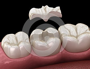 Inlay ceramic crown fixation over tooth. Medically accurate 3D illustration of human teeth treatment