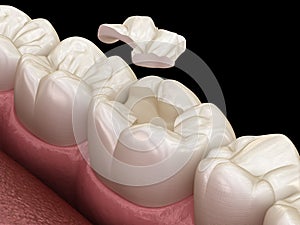 Inlay ceramic crown fixation over tooth. Medically accurate 3D illustration of human teeth photo