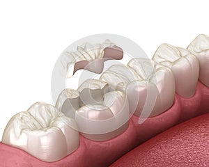 Inlay ceramic crown installation in to the tooth. Medically accurate 3D illustration of human teeth treatment