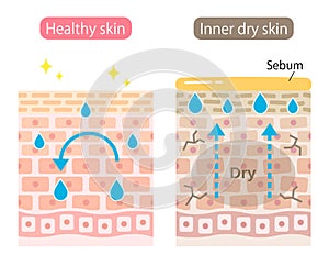 Inner dry and healthy skin cell layer. skin produce extra sebum to moisturize but below is dehydrated due to water loss. Skin care