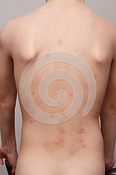 Insect bites on the child`s body
