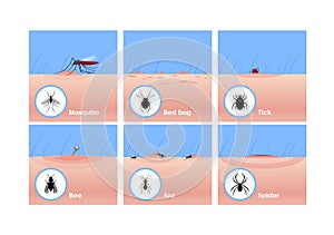 Insect bites flat vector illustrations set. Mosquito drinking blood, tick getting under skin, bee sting. Bed bug, ant