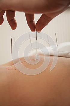 Inserting Acupuncture Needles