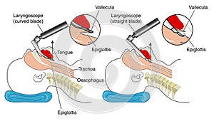 Inserting a laryngoscope photo