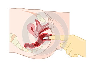 Insertion of suppository