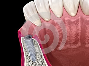 Instaled dental implantat. Medically accurate tooth 3D illustration