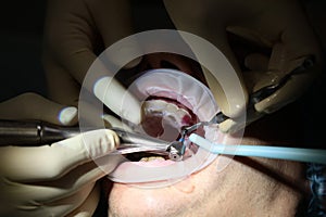 Installation of a dental implant. A real operation. Close-up. An open mouth. Dentistry and the concept of dental care
