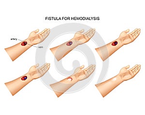 Installation of fistula for hemodialysis photo