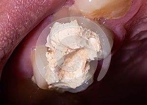 Installation of a temporary filling in the treatment of tooth canals, endodontics. Tooth pulpitis in dentistry, macro