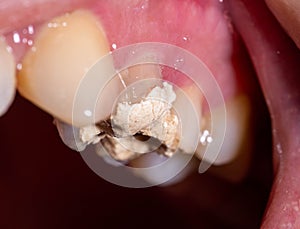 Installation of a temporary filling in the treatment of tooth canals, endodontics. Tooth pulpitis in dentistry, macro