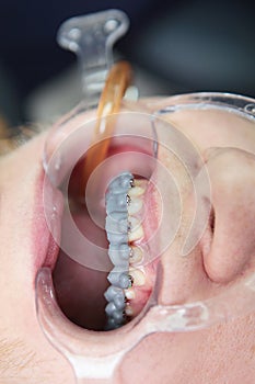 Installing braces on the upper row of teeth.Alignment of the dentition or bite. The concept of beauty and health. Macro photo