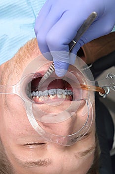 Installing braces on the upper row of teeth.Alignment of the dentition or bite. Tweezers in the doctor`s hand. The photo