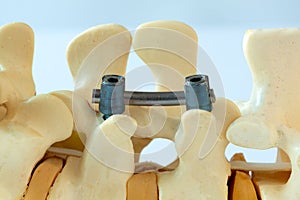 Instrument fixation of human lumbar spine model