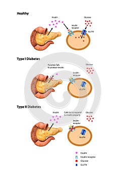 Insulin action and diabetes type 1 and 2, 2d 3d graphic, render