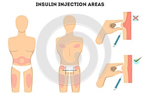 Insulin injections places.