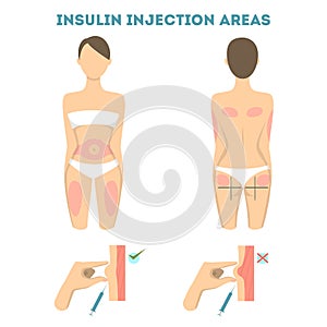 Insulin injections places. photo