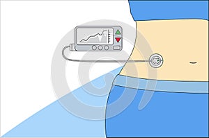 Insulin pump machinery diabetes connected in his abdomen.Concept flat style vector medical illustration_10_EPS10