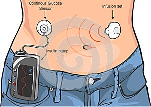 Insulin Pumps for Diabetes Patients Vector ÃÂ°llustration