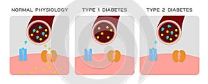 Insulin type / normal physiology , diabetes / unlocks the cell`s glucose channel animation graphic photo