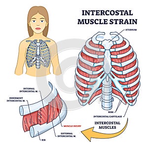 Intercostal muscle strain as muscular group in chest cavity outline diagram