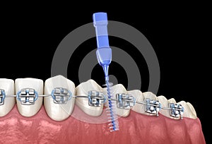 Interdental tooth brush and braces cleaning. Medically accurate illustration of oral hygiene