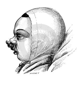 Intermaxillary bone projection, insertion of the middle lobule of the lip at the tip of the nose in the old book D`Anatomie