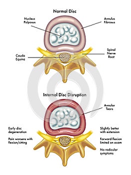 internal disc disruption photo