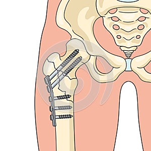 Internal fixation repairing bone medical science